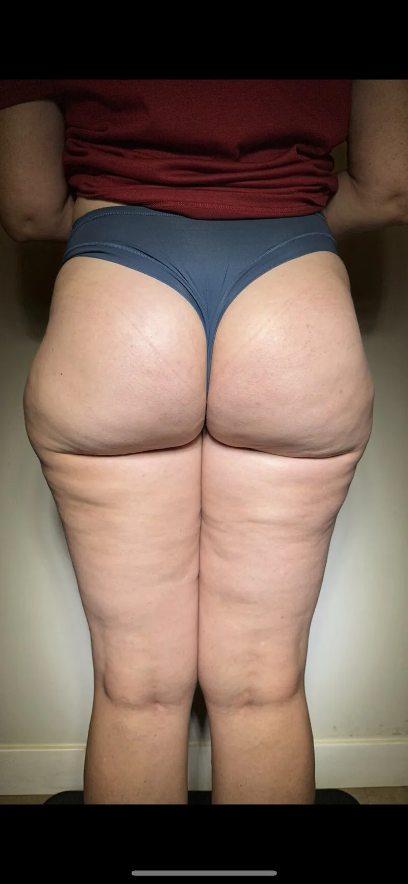 Antes do Dream Incision
